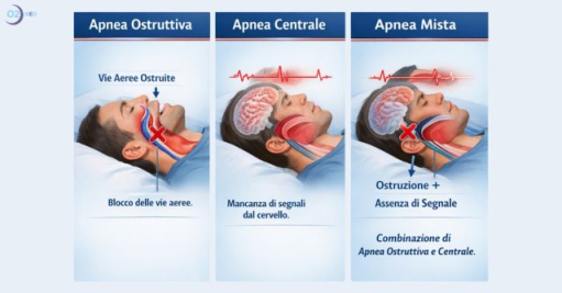 Le Apnee Notturne e i Disturbi Respiratori del Sonno - Tipi, Sintomi, Terapie e Conseguenze